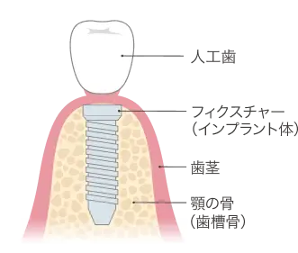 インプラントの基本構造
