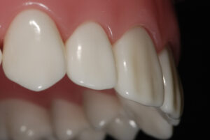 インプラント治療におけるサイナスリフトとは？ほかの骨造成手術との違いや術後の注意点