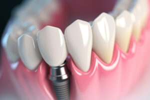 ストローマンのインプラントの価格は？特徴・評判と多くの歯科医院に選ばれる理由