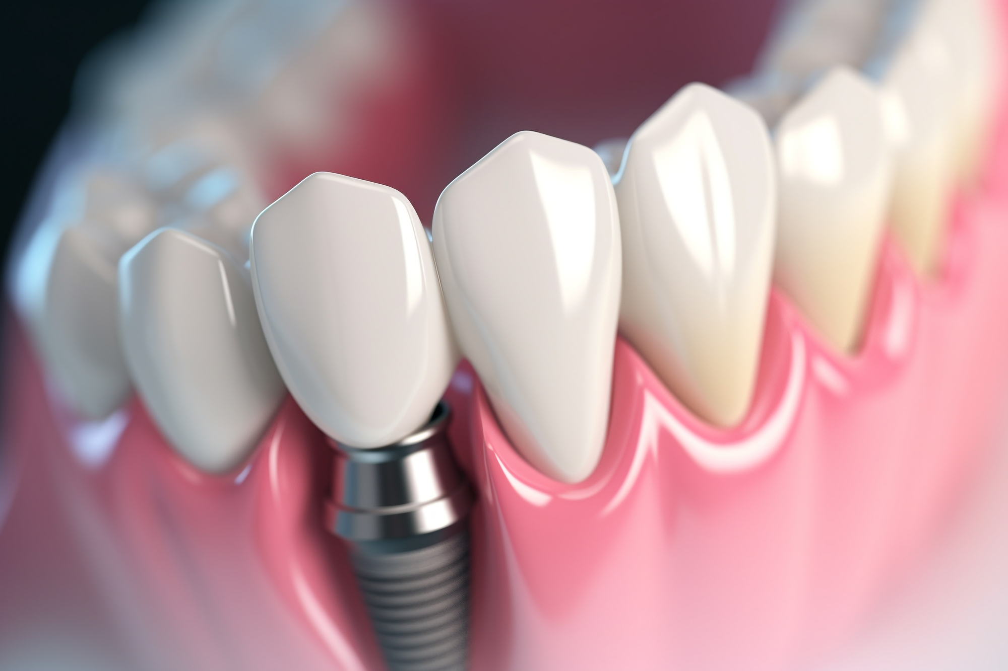 ストローマンのインプラントの価格は？特徴・評判と多くの歯科医院に
